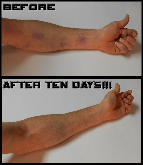 Top 96+ Images Pictures Of Bruising After Blood Draw Excellent